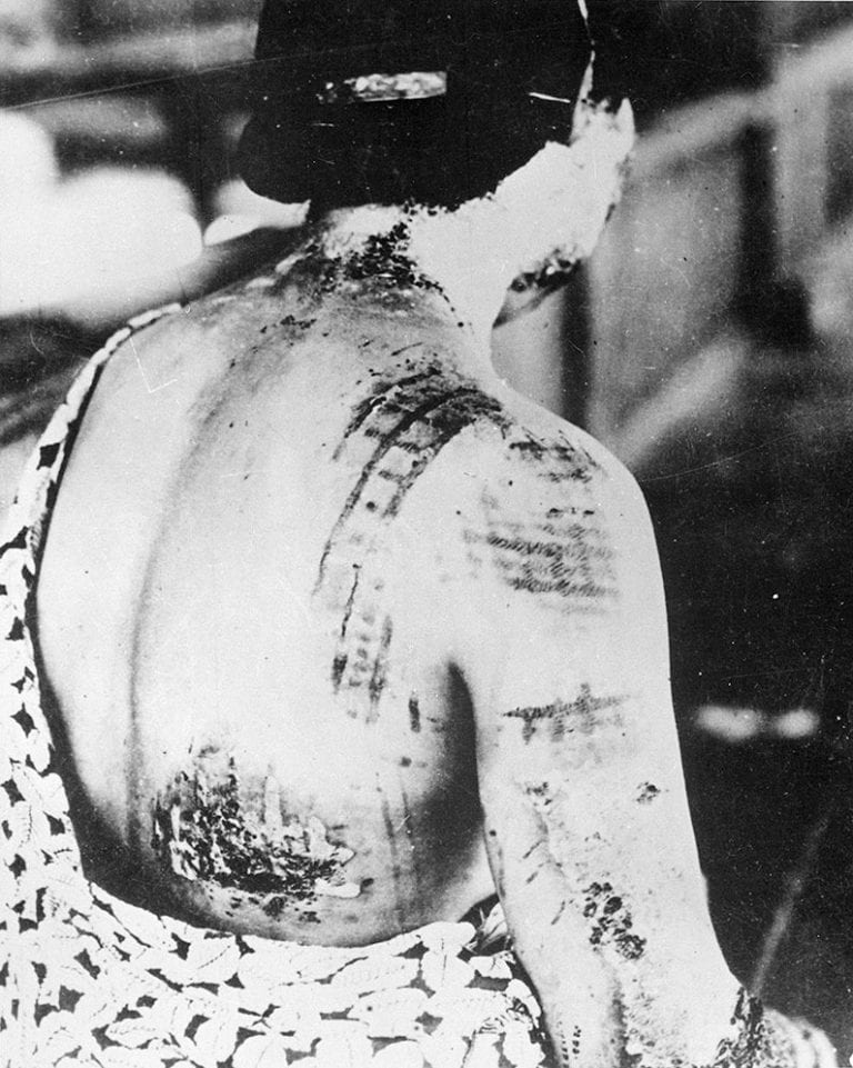 Hibakusha victim